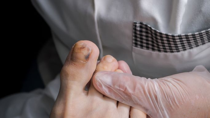 Czerniak paznokcia to odmiana nowotworu złośliwego, rozpoznawana co roku u 2 500 osób.