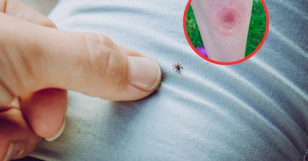 Kleszcze wywołują boreliozę. By się ochronić, koniecznie zrób to po spacerze