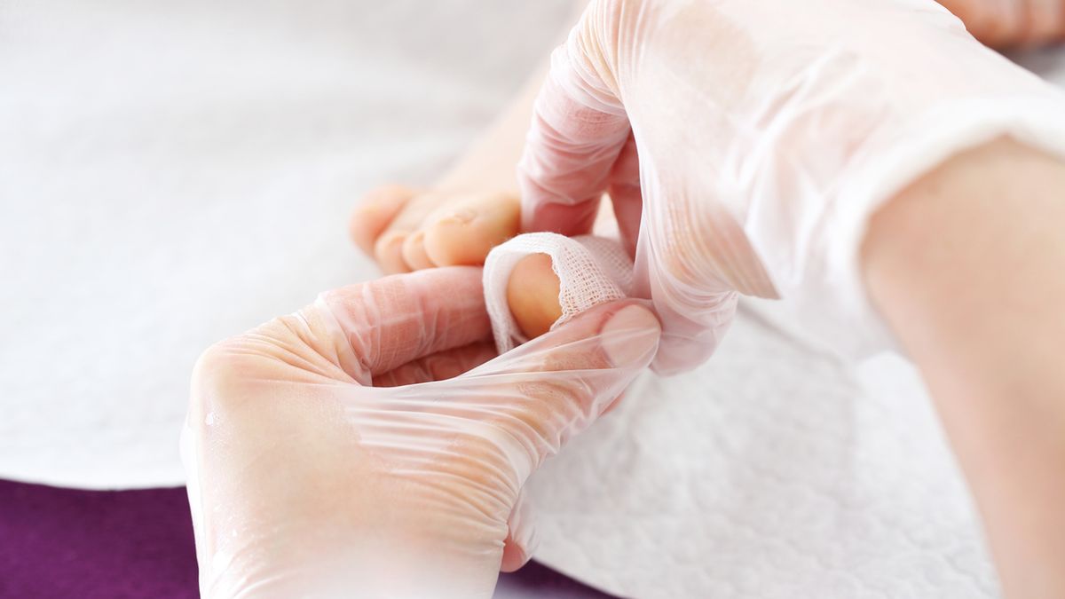 Kostka Arkady służy do korekcji wrastających paznokci.