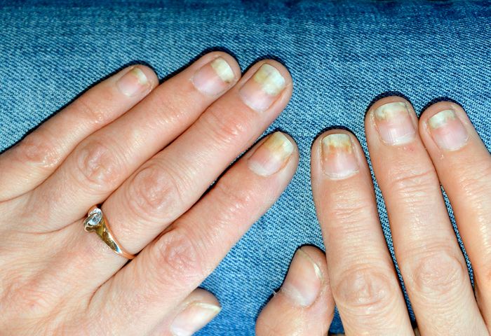 Łuszczyca paznokci może prowadzić do zniszczenia płytki paznokciowej