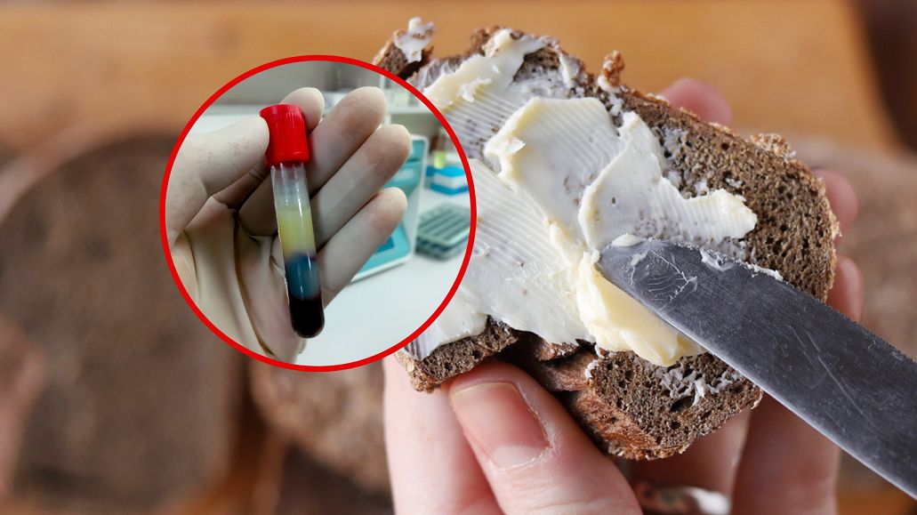 Wysoki cholesterol może skutkować zawałem lub miażdżycą.