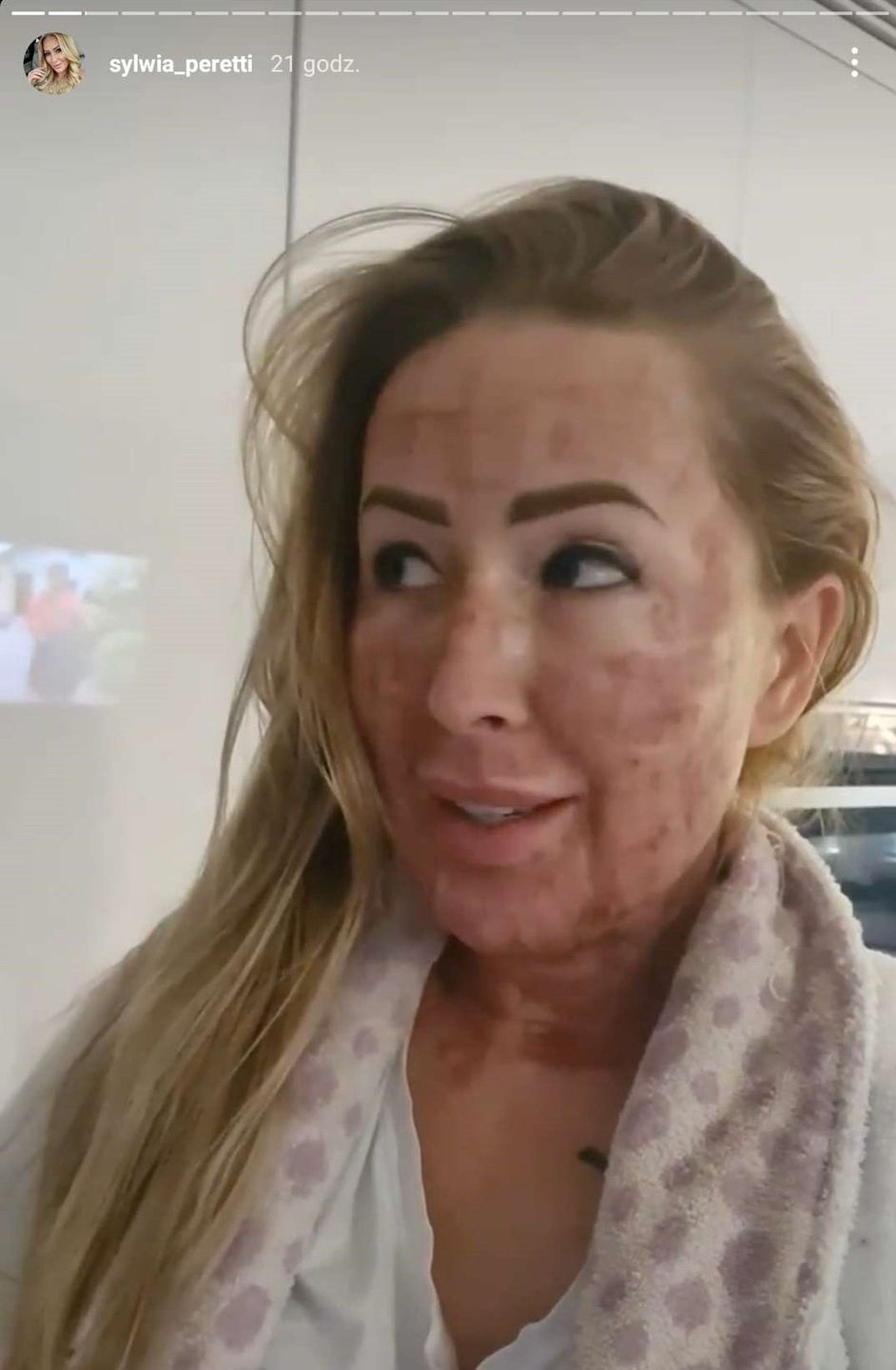 Sylwia Peretti pokazuje kolejny etap po zabiegu laserowym. Jest lepiej? 