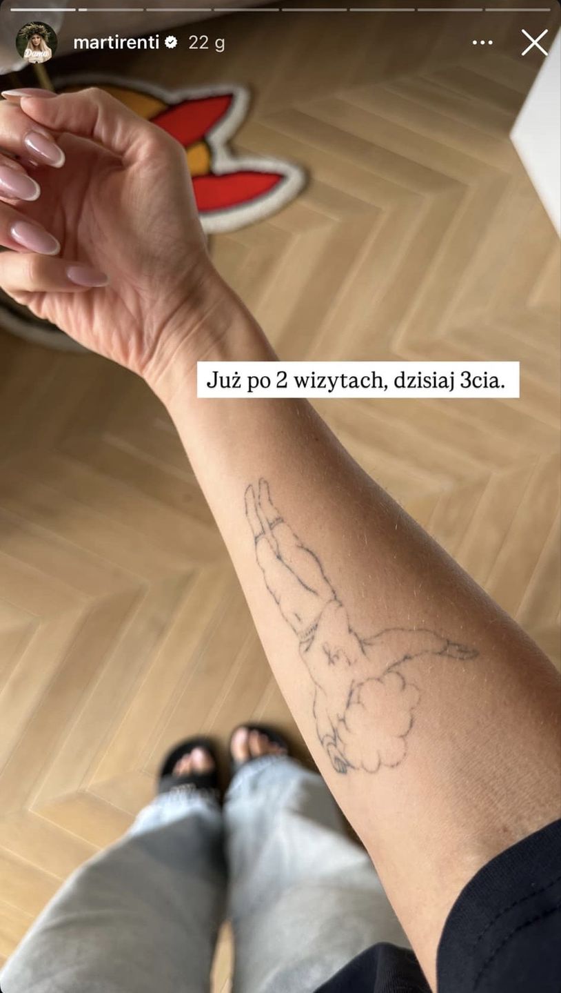 Martirenti usuwa tatuaże 