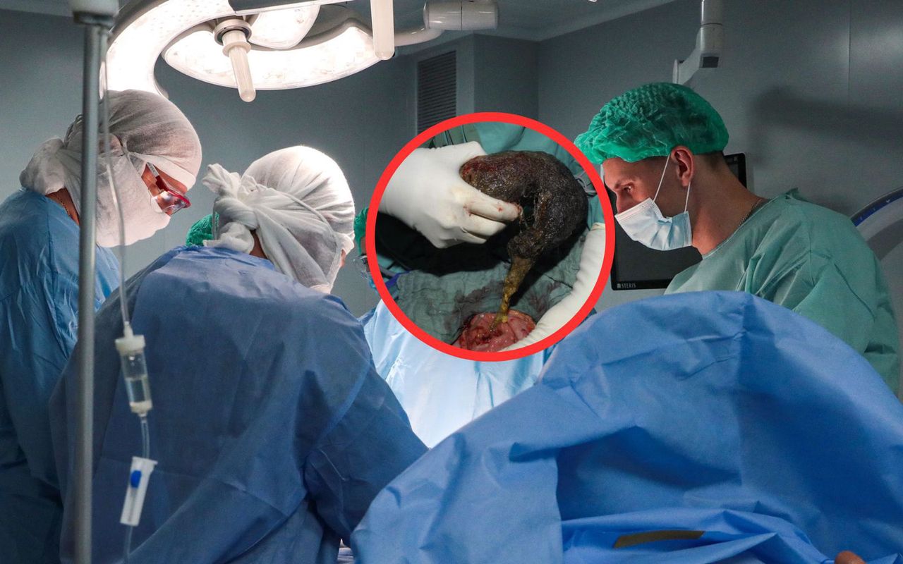 To była kula włosów. Odkrycie w żołądku 10-latki z Indii