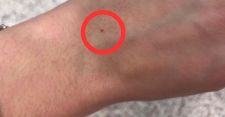 Masz pieprzyk w tym miejscu? To nie jest przypadek