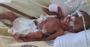 Natan ważył nieco ponad 600 GRAMÓW! Skrajny WCZEŚNIAK potrzebuje wsparcia