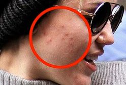 Miley Cyrus: Nie taka idealna! Twarz pełna pryszczy