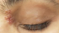 Półpasiec oczny - objawy, leczenie i powikłania