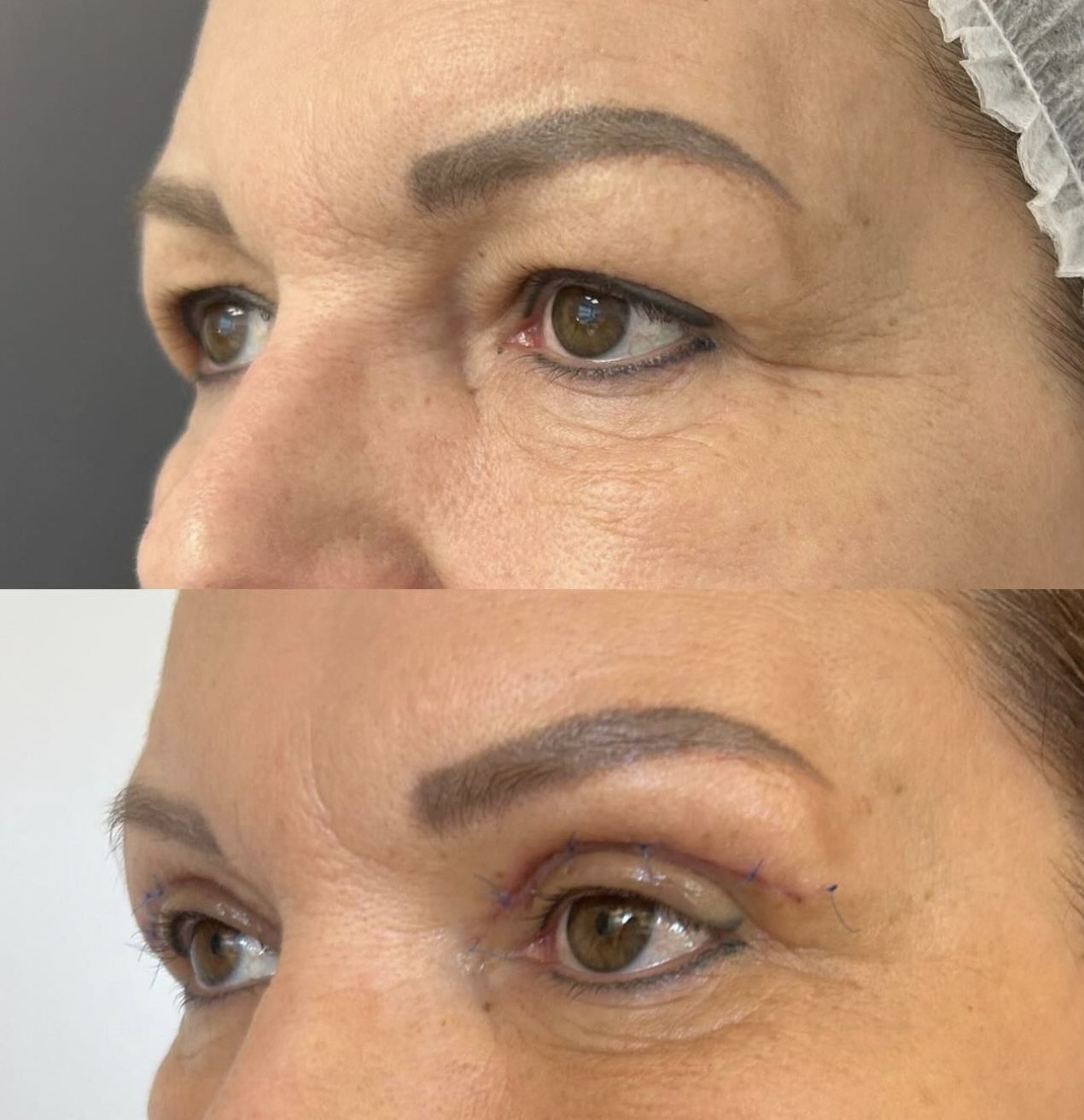 Ilona Felicjańska przed i po zabiegu