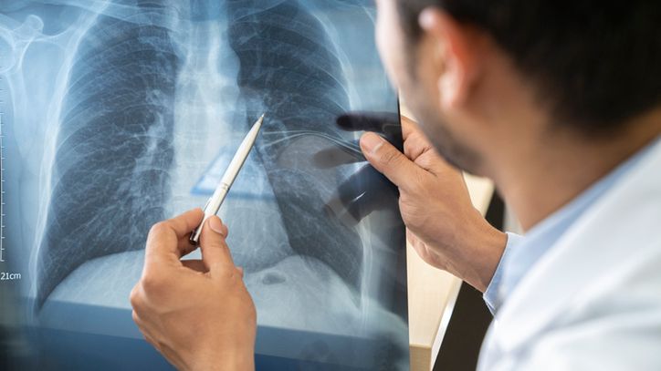 Beryloza to przewlekła choroba płuc. 