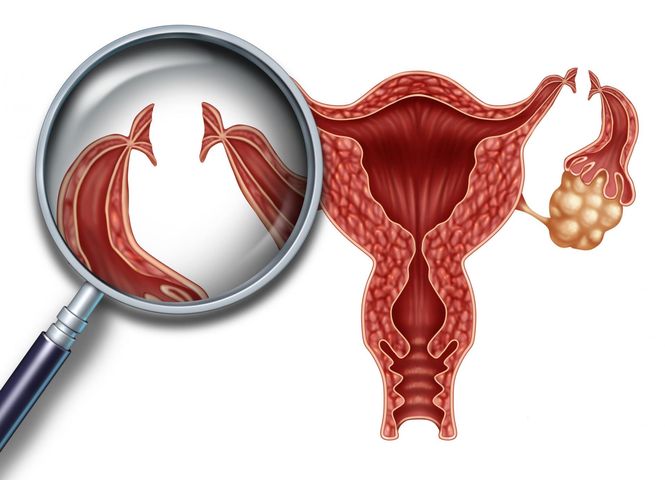 Zabieg podwiązania jajowodów jest przeprowadzany u kobiety w celu uzyskania trwałej, skutecznej antykoncepcji