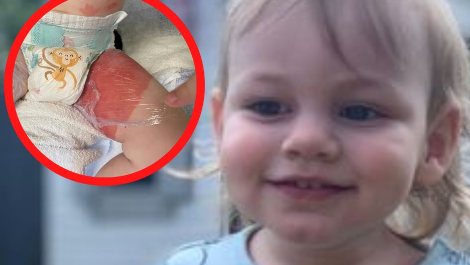 Roczne dziecko wylało na siebie wrzątek