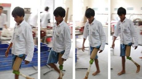 Student skonstruował protezę kolana za 20 USD 1