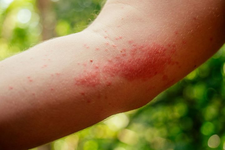 Objawy alergii na słońce. Dotyka dzieci i dorosłych