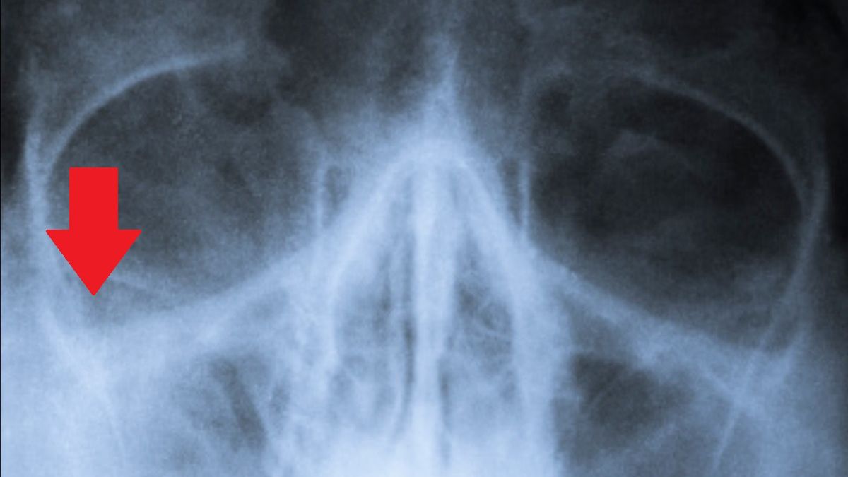 Borykasz się z chronicznym katarem? Naukowcy przedstawili nową teorię, z czego może wynikać taki stan rzeczy