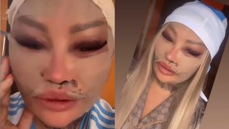 Laluna prezentuje w przybliżeniu pooperacyjne lico i wymienia, co tym razem poprawiła: "Będę miała BARBIE BABY FACE"
