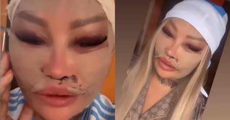 Laluna prezentuje w przybliżeniu pooperacyjne lico i wymienia, co tym razem poprawiła: "Będę miała BARBIE BABY FACE"