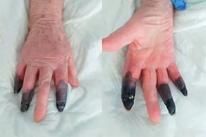 Palce zakażonej kobiety