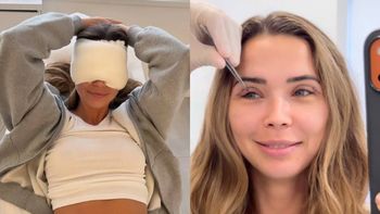 Sandra Kubicka zaprezentowała się fanom po ściągnięciu szwów: "Wyglądam jeszcze jak dzwonnik z Notre Dame" (FOTO)