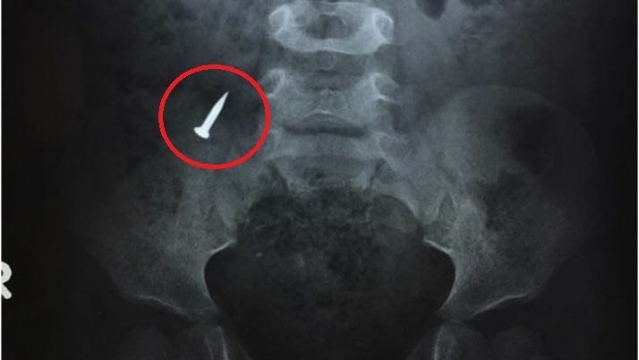 Czterolatek połknął gwóźdź. Chłopiec musiał przejść operację