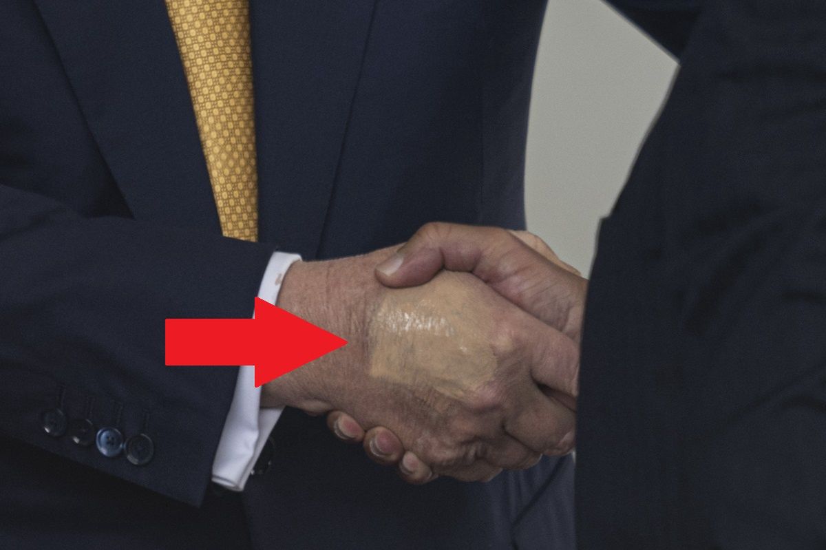 Zauważyli plamę na dłoni Trumpa. "Lekarze próbują ukryć siniaki"