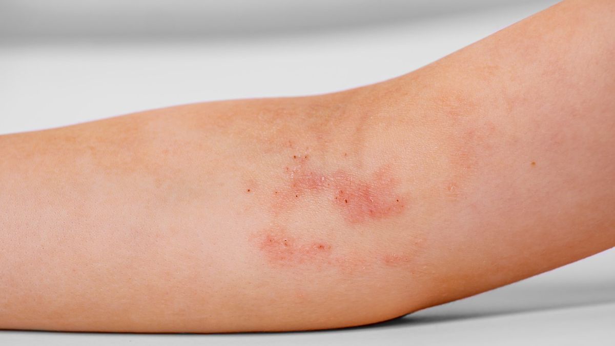 Przeczosy to powierzchniowe ubytki o liniowym kształcie na skórze uprzednio niezmienionej.