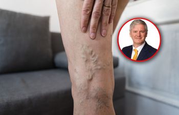 Mróz sprzyja zakrzepom. Chirurg mówi, co rozrzedza krew i pomaga na żylaki