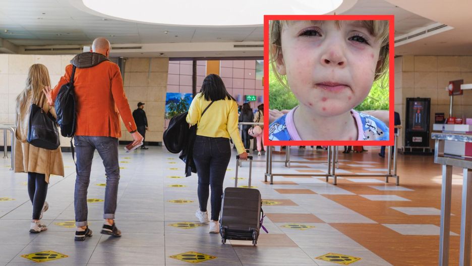 Ospa wietrzna zostawia blizny na całe życie. Rodzice wciąż lekceważą chorobę