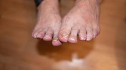 Subtelny objaw wysokiego cholesterolu. Pojawia się w czasie chodzenia