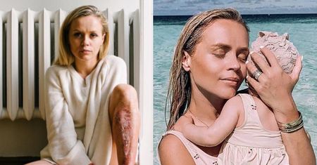 Córka Anny Skury wylała na nią WRZĄTEK. Influencerka pokazała poparzenia (FOTO)