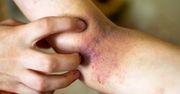 To nie jest zwykła wysypka. Znak, że nowotwór dewastuje wątrobę