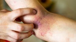 To nie jest zwykła wysypka. Znak, że nowotwór dewastuje wątrobę
