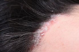 Swędząca skóra głowy – przyczyny, objawy i leczenie