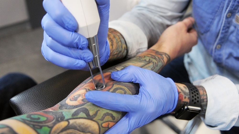 Usuwanie tatuażu to długotrwały, niezbyt przyjemny i kosztowny proces