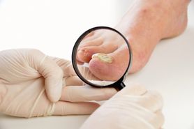 8 powodów, które mogą być przyczyną odbarwienia paznokci