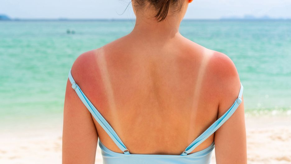 beach, sunburn, summer, skin, damage, red, burn, outdoors, back, sunbathing, sea, swimsuit, ultraviolet, body, adult, background, bikini, cancer, care, dermatology, female, girl, heat, holiday, hot, hurt, painful, people, person, problem, redness, shoulder, sun, sunny, suntan, surfer, tan, tanned, uv, vacation, water, woman, young