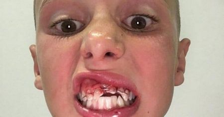 Groźny wypadek na basenie. Lekarzom udało się uratować uśmiech chłopca