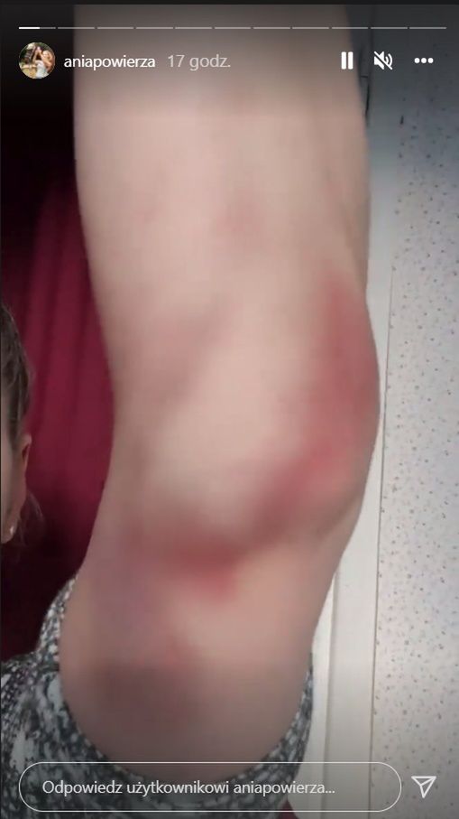 Anna Powierza pokazała koszmarne zdjęcia. Tak pobrano jej krew