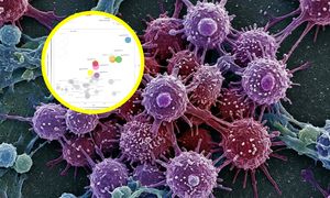 Sztuczna inteligencja w walce z rakiem. Algorytm przewiduje ryzyko przerzutów