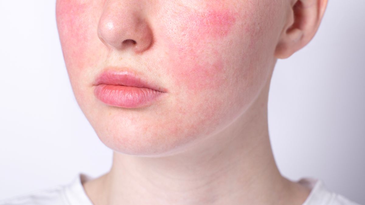 Cera wrażliwa wymaga odpowiedniej pielęgnacji.