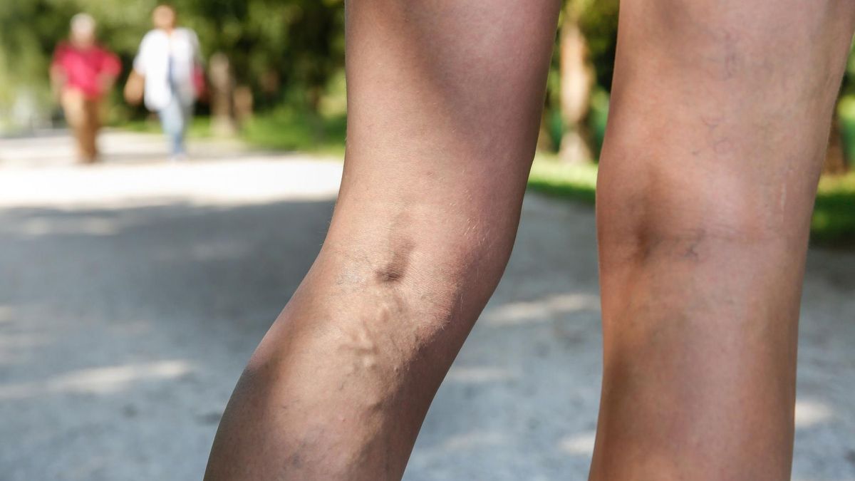 Nieestetyczne żylaki na nogach