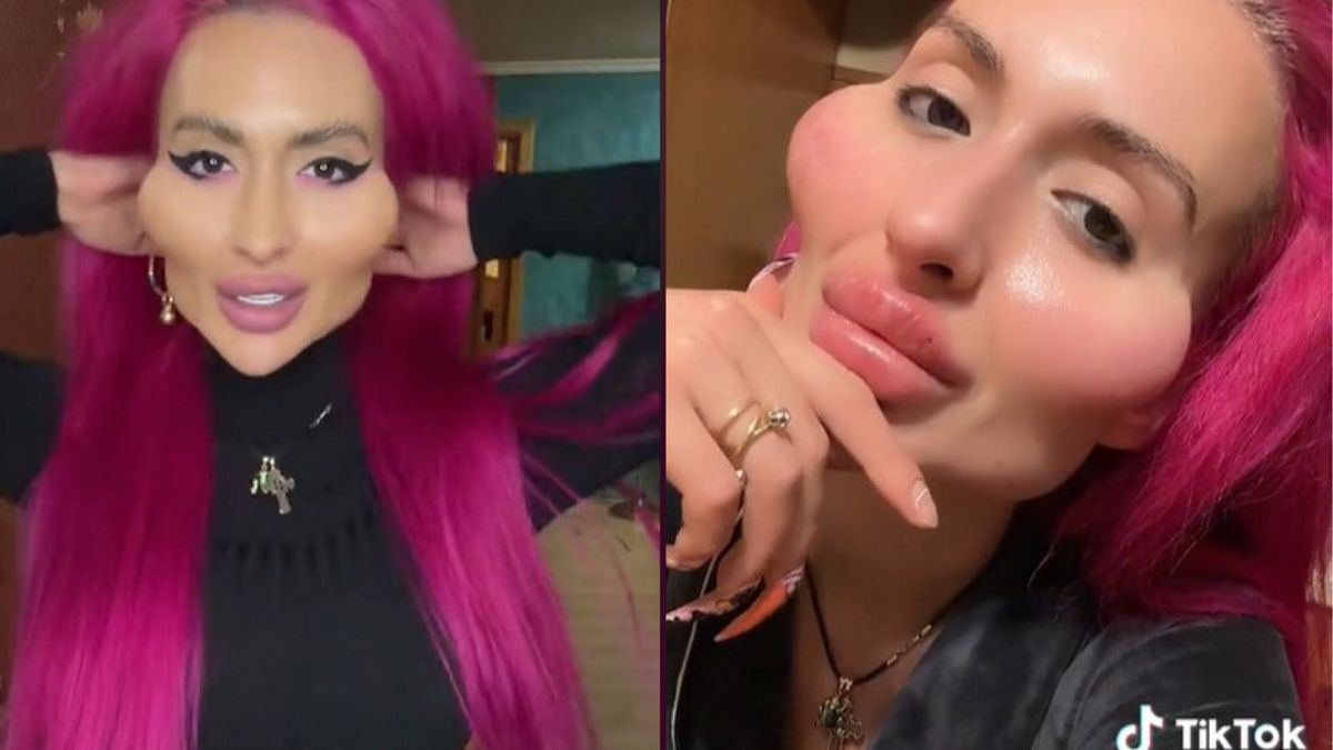 Ma największe kości policzkowe na świecie. Zdecydowała, że jeszcze bardziej je powiększy.