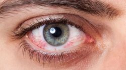 Zapalenie spojówek a alergia - jak rozróżnić? Porady eksperta