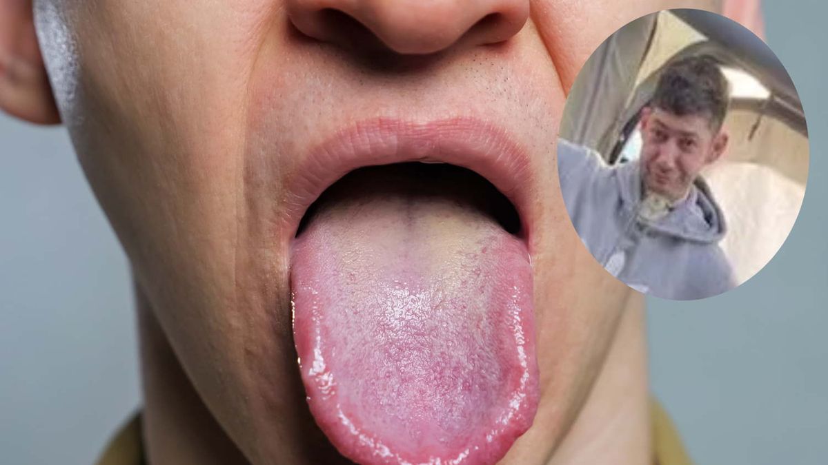 Lekarze musieli usunąć język Scottowi