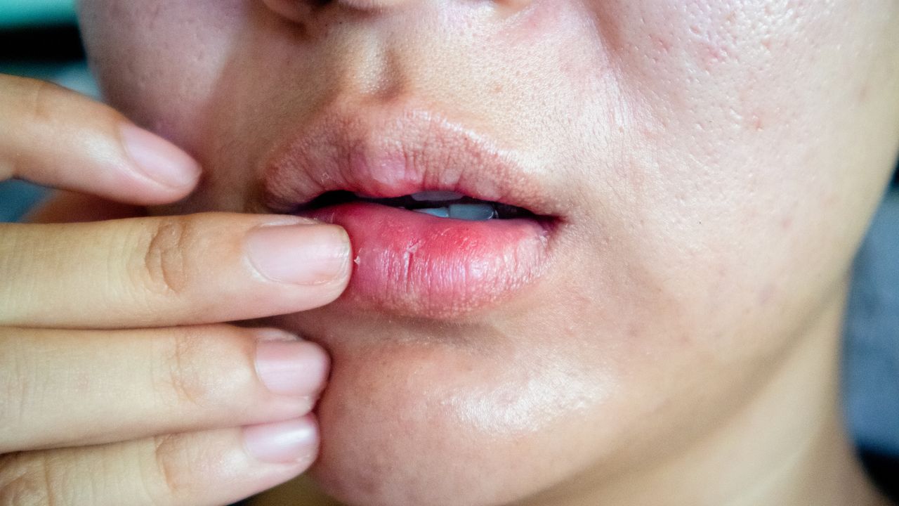 Warning signs of skin cancer: What chapped lips and nails reveal