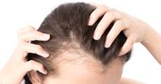 Łysienie androgenowe - przyczyny i leczenie