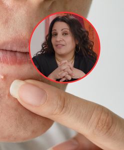 Wyciskasz pryszcze? Dermatolożka bije na alarm
