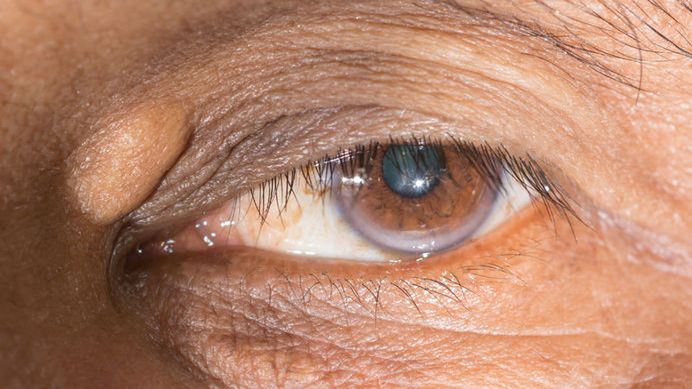 Kępki żółte mogą być objawem zbyt wysokiego poziomu cholesterolu