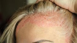 Czynnik wyzwalający łuszczycy. Decydujące może być zapalenie gardła