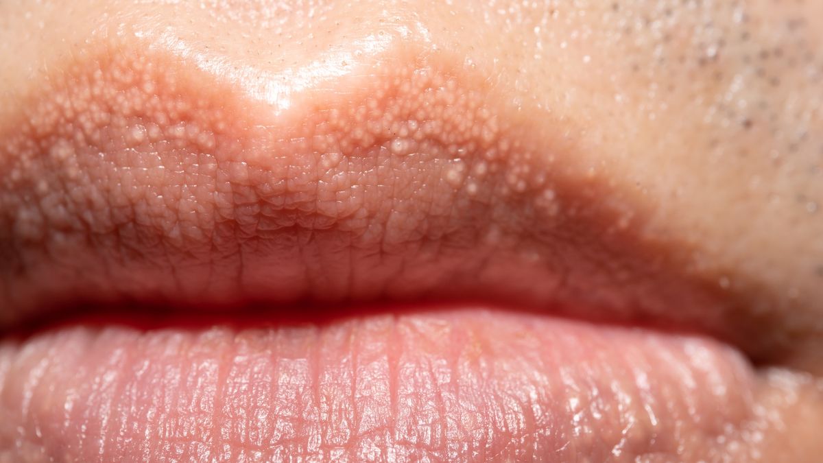 close up of Fordyce Spots on Lips
close up of Fordyce Spots on Lips
Wongsakorn Napaeng